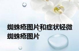 蜘蛛疮图片和症状轻微 蜘蛛疮图片 